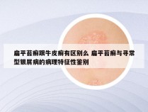 扁平苔癣跟牛皮癣有区别么 扁平苔癣与寻常型银屑病的病理特征性鉴别