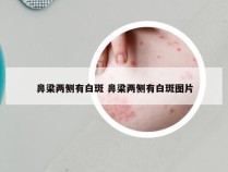 鼻梁两侧有白斑 鼻梁两侧有白斑图片