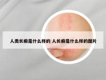人类长癣是什么样的 人长癣是什么样的图片