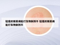 轻度的银屑病能打生物制剂不 轻度的银屑病能打生物制剂不