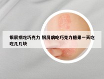 银屑病吃巧克力 银屑病吃巧克力糖果一天吃吃几几块