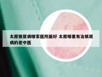 太原银屑病哪家医院最好 太原哪里有治银屑病的老中医