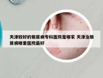 天津较好的银屑病专科医院是哪家 天津治银屑病哪里医院最好