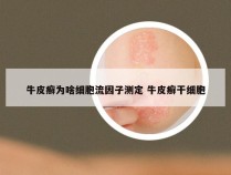 牛皮癣为啥细胞流因子测定 牛皮癣干细胞