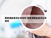 银屑病血液净化有效吗 银屑病做血液净化有用吗