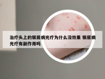 治疗头上的银屑病光疗为什么没效果 银屑病光疗有副作用吗