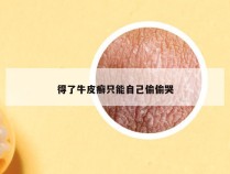 得了牛皮癣只能自己偷偷哭
