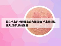 长在手上的神经性皮炎和银屑病 手上神经性皮炎,湿疹,癣的区别