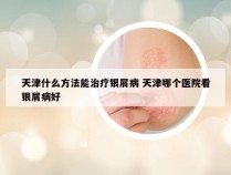 天津什么方法能治疗银屑病 天津哪个医院看银屑病好