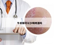 牛皮癣可以少喝啤酒吗