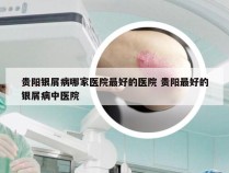 贵阳银屑病哪家医院最好的医院 贵阳最好的银屑病中医院