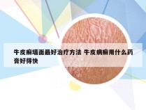牛皮癣墙面最好治疗方法 牛皮病癣用什么药膏好得快