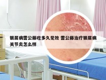 银屑病雷公藤吃多久见效 雷公藤治疗银屑病关节炎怎么样