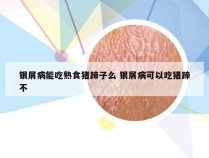 银屑病能吃熟食猪蹄子么 银屑病可以吃猪蹄不
