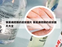银屑病初期的症状图片 银屑病初期的症状图片大全