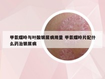 甲氨蝶呤与叶酸银屑病用量 甲氨蝶呤片配什么药治银屑病