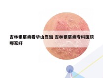 吉林银屑病看华山靠谱 吉林银屑病专科医院哪家好