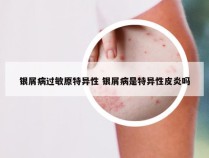 银屑病过敏原特异性 银屑病是特异性皮炎吗