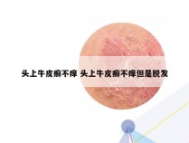 头上牛皮癣不痒 头上牛皮癣不痒但是脱发