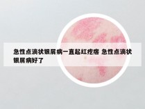 急性点滴状银屑病一直起红疙瘩 急性点滴状银屑病好了