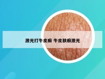 激光打牛皮癣 牛皮肤癣激光
