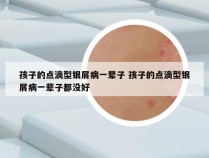 孩子的点滴型银屑病一辈子 孩子的点滴型银屑病一辈子都没好