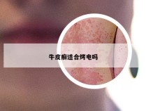 牛皮癣适合烤电吗