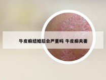 牛皮癣结婚后会严重吗 牛皮癣夫妻