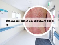 银屑病关节炎用药好大夫 银屑病关节炎外用药