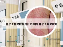 肚子上有皮肤癣是什么原因 肚子上长皮肤癣