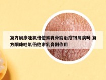 复方酮康唑氯倍他索乳膏能治疗银屑病吗 复方酮康唑氯倍他索乳膏副作用