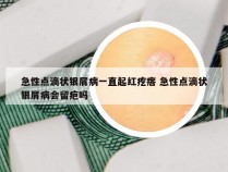 急性点滴状银屑病一直起红疙瘩 急性点滴状银屑病会留疤吗