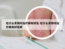 吃什么食物对治疗癣有好处 吃什么食物对治疗癣有好处呢