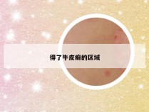 得了牛皮癣的区域