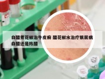 白醋煮花椒治牛皮癣 醋花椒水治疗银屑病 白醋还是陈醋