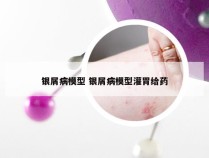 银屑病模型 银屑病模型灌胃给药