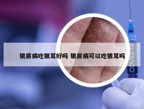 银屑病吃银耳好吗 银屑病可以吃银耳吗