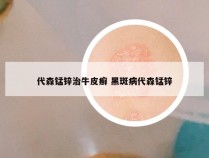 代森锰锌治牛皮癣 黑斑病代森锰锌