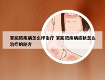 掌跖脓疱病怎么样治疗 掌跖脓疱病症状怎么治疗的秘方