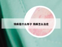 钱癣是什么样子 钱癣怎么治愈