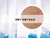 长癣了 长癣了怎么治