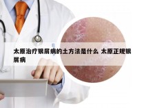 太原治疗银屑病的土方法是什么 太原正规银屑病