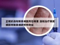 正规的洛阳银屑病医院在哪里 洛阳治疗银屑病郑州银屑病研究院地址