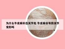 为什么牛皮癣长在关节处 牛皮癣会导致关节变形吗