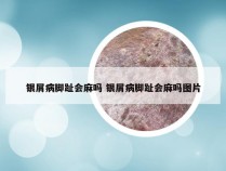 银屑病脚趾会麻吗 银屑病脚趾会麻吗图片