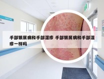 手部银屑病和手部湿疹 手部银屑病和手部湿疹一样吗