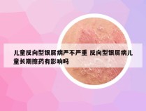 儿童反向型银屑病严不严重 反向型银屑病儿童长期擦药有影响吗