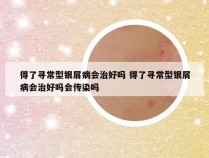 得了寻常型银屑病会治好吗 得了寻常型银屑病会治好吗会传染吗