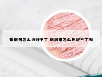 银屑病怎么也好不了 银屑病怎么也好不了呢