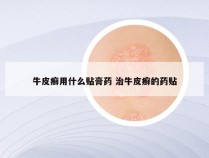 牛皮癣用什么贴膏药 治牛皮癣的药贴